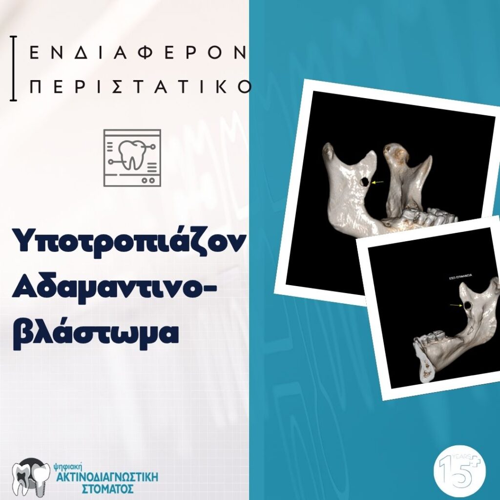 Υποτροπιάζον Αδαμαντινοβλάστωμα 13 Ακτινοδιαγνωστική Ενδιαφέρον περιστατικό Oct 24